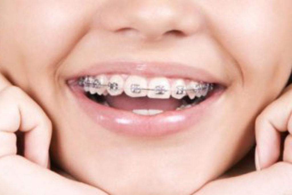 tony weir orthodontist brisbane braces