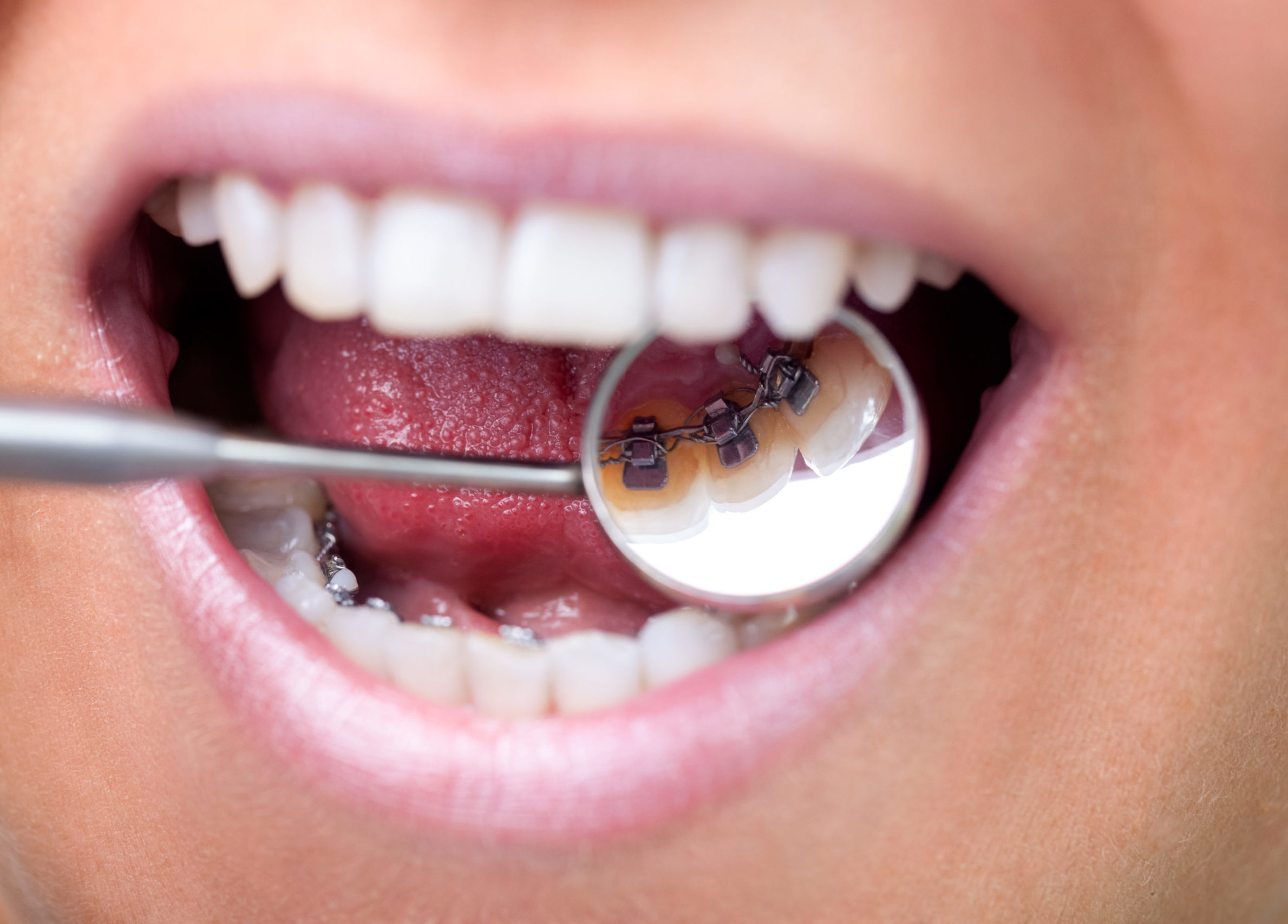 tony weir orthodontist brisbane lingual braces