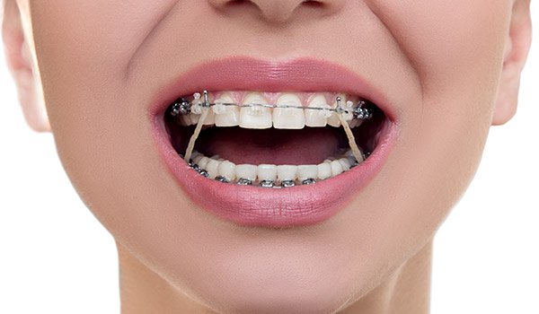tony weir orthodontist brisbane braces and elastics