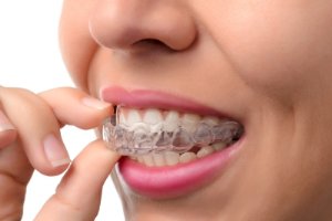 Close up of woman’s hand and mouth, putting Invisalign aligner onto teeth